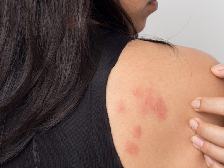 చర్మం పై కరోనా ప్రభావం… రంగు మారుతుందా?