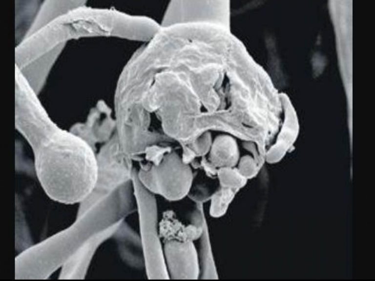 చిత్తూరు జిల్లాలో పెరుగుతున్న బ్లాక్ ఫంగ‌స్ కేసులు… ఒక్క‌రోజులో…