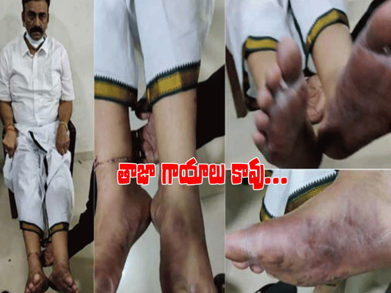 రఘురామ కాలిపై గాయాలు లేవు.. స్పష్టం చేసిన మెడికల్ రిపోర్టు