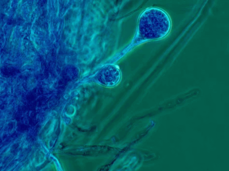 ఏపీలో బ్లాక్ ఫంగస్ కలకలం…