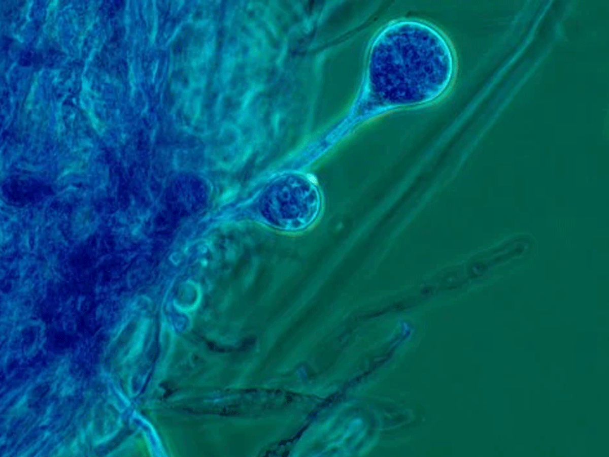 ఏపీలో బ్లాక్ ఫంగస్ కలకలం…