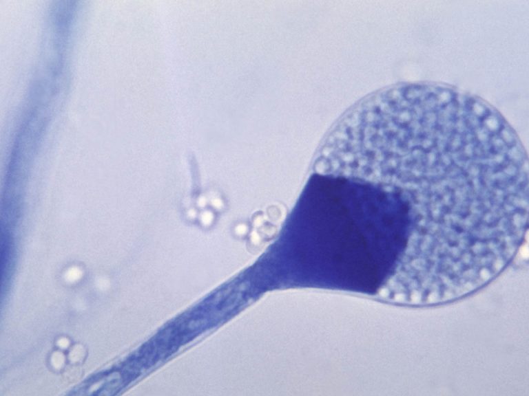 చిత్తూరు జిల్లాలో విజృంభిస్తున్న బ్లాక్ ఫంగ‌స్ కేసులు…