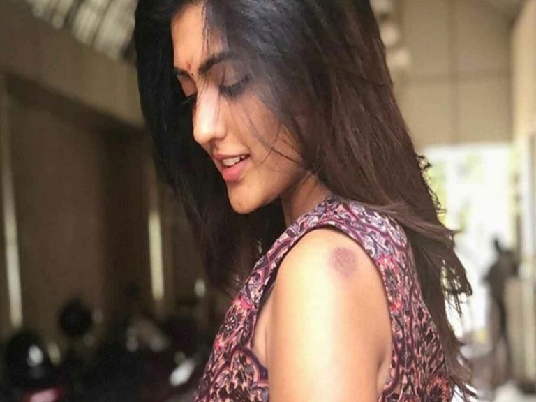 ఈషాకు గాయం.. ఆ మచ్చపై అభిమానుల ఆందోళన