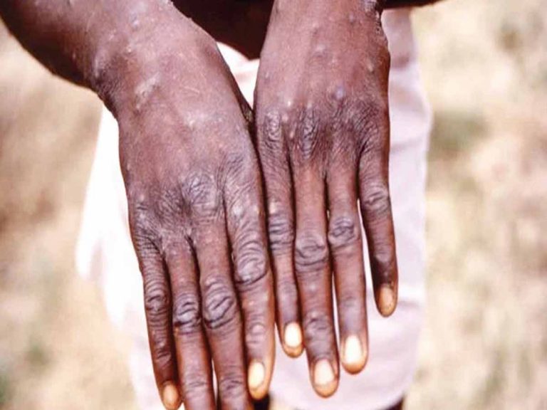 18 ఏళ్ల త‌రువాత మ‌రోసారి ఆ వ్యాధి…