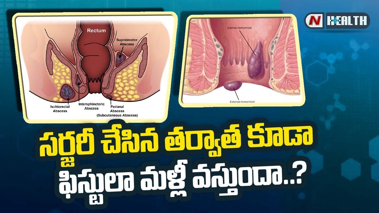 సర్జరీ చేసిన తర్వాత కూడా ఫిస్టులా వస్తుందా..?
