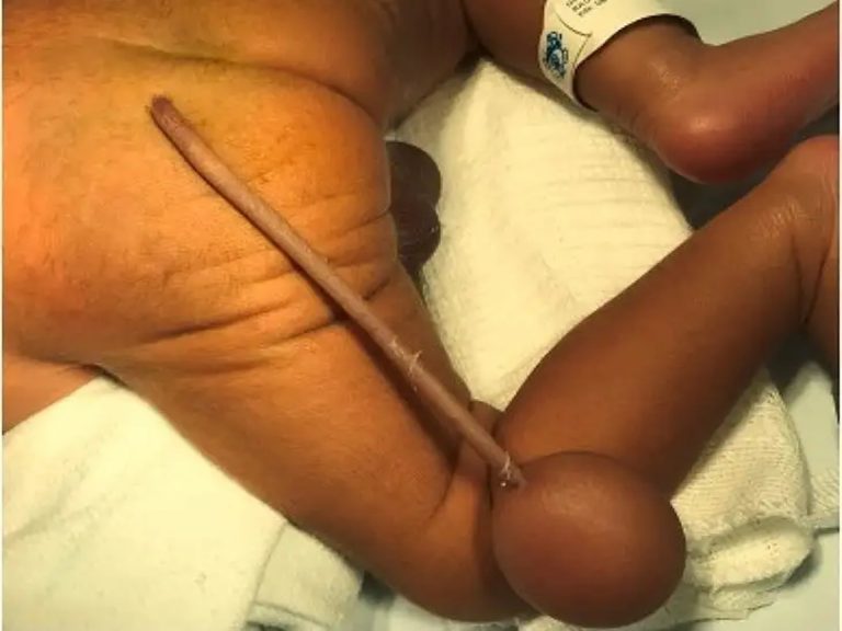 ఆంజనేయుడు మళ్లీ పుట్టాడా?… తోకతో జన్మించిన బాలుడు