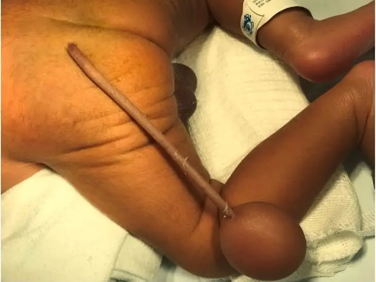 ఆంజనేయుడు మళ్లీ పుట్టాడా?… తోకతో జన్మించిన బాలుడు