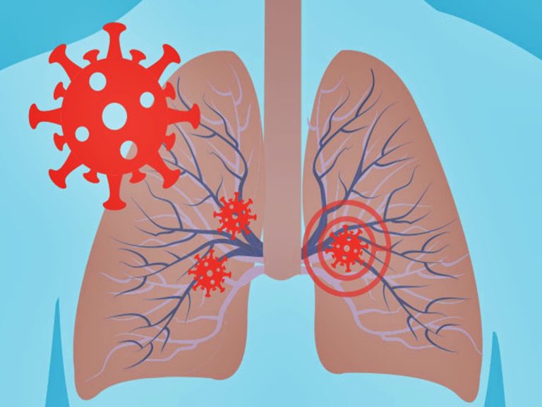 Lung Infections: జాగ్రత్త మిత్రమా.. ఊపిరితిత్తుల ఇన్‌ఫెక్షన్ల బరిన పడ్డవారిలో మగవారే అధికం..