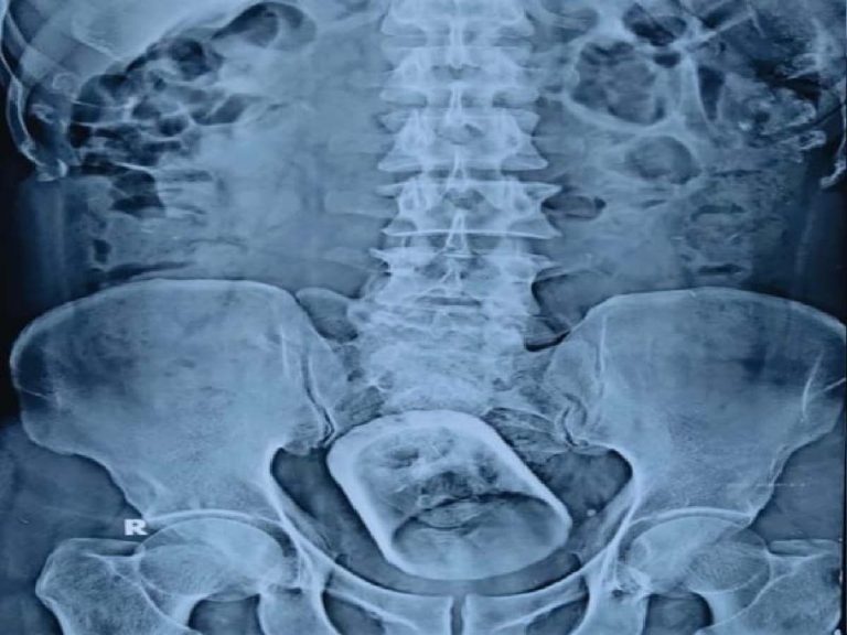 Viral:  క‌డుపులో చాయ్‌గ్లాస్‌… షాకైన వైద్యులు…