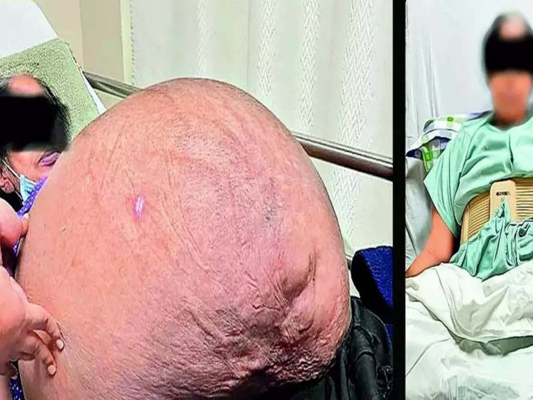 Shocking:  మ‌హిళ శ‌రీరంలో 47 కేజీల క‌ణితి… 18 ఏళ్లుగా మోస్తూ…