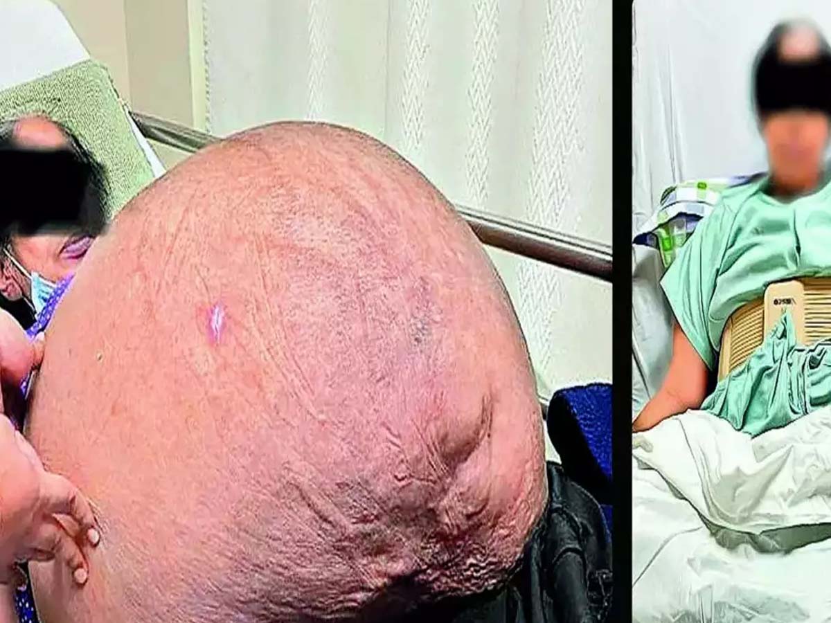 Shocking:  మ‌హిళ శ‌రీరంలో 47 కేజీల క‌ణితి… 18 ఏళ్లుగా మోస్తూ…