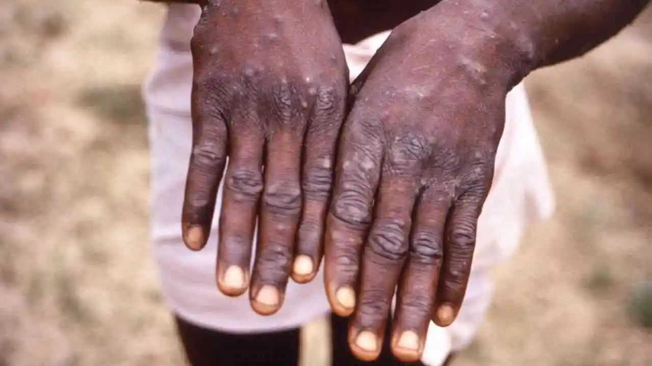 Monkeypox: మంకీపాక్స్ పై కేరళ సర్కార్ అలెర్ట్