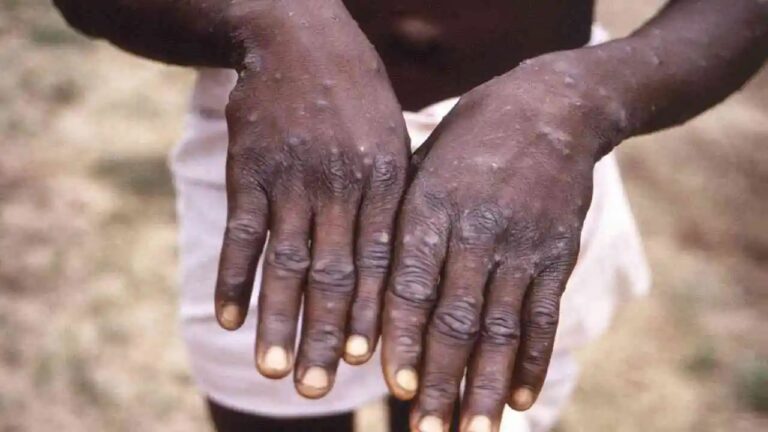 Monkeypox: మరో రెండు దేశాల్లో మంకీపాక్స్… ప్రమాదమే అంటున్న డబ్ల్యూహెచ్ఓ