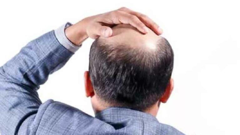 బట్టతలకు మందు వచ్చిందోచ్.. ఇక మీ జుట్టు మీ సొంతం