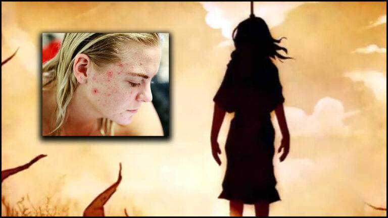 Crime News: యువతిని బలి తీసుకున్న ‘మొటిమలు’