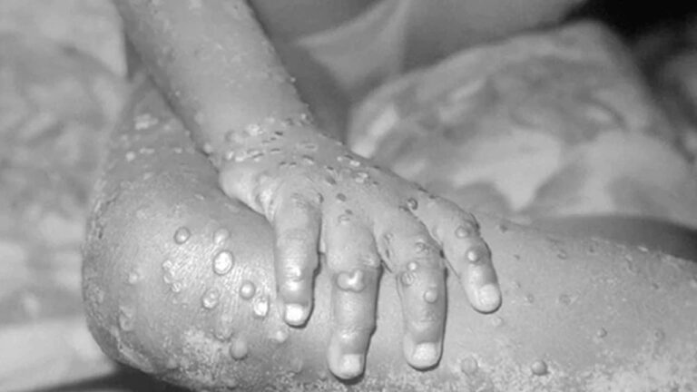 Monkeypox: మంకీపాక్స్ వైరస్‌.. తెలంగాణ అలర్ట్‌