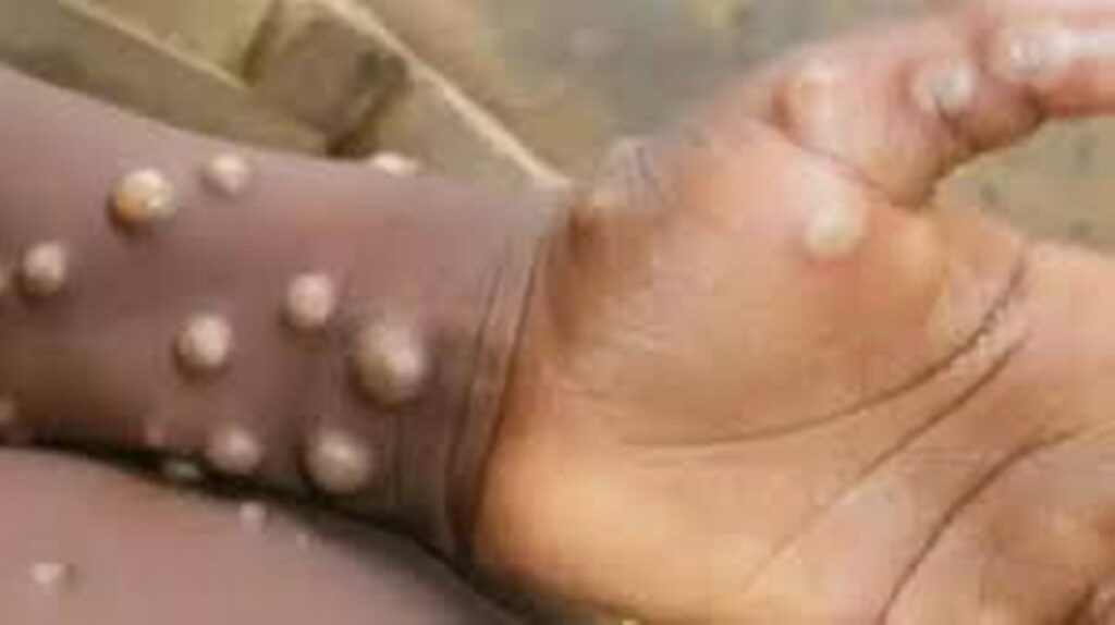 Monkeypox