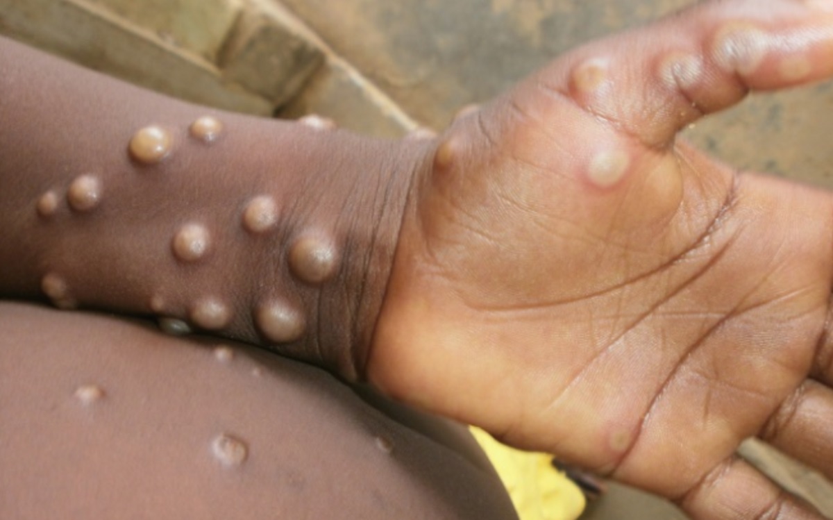 Monkeypox: ఇంగ్లాండ్ లో మంకీపాక్స్ కలకలం… అత్యంత అరుదైన వైరస్ గా గుర్తింపు