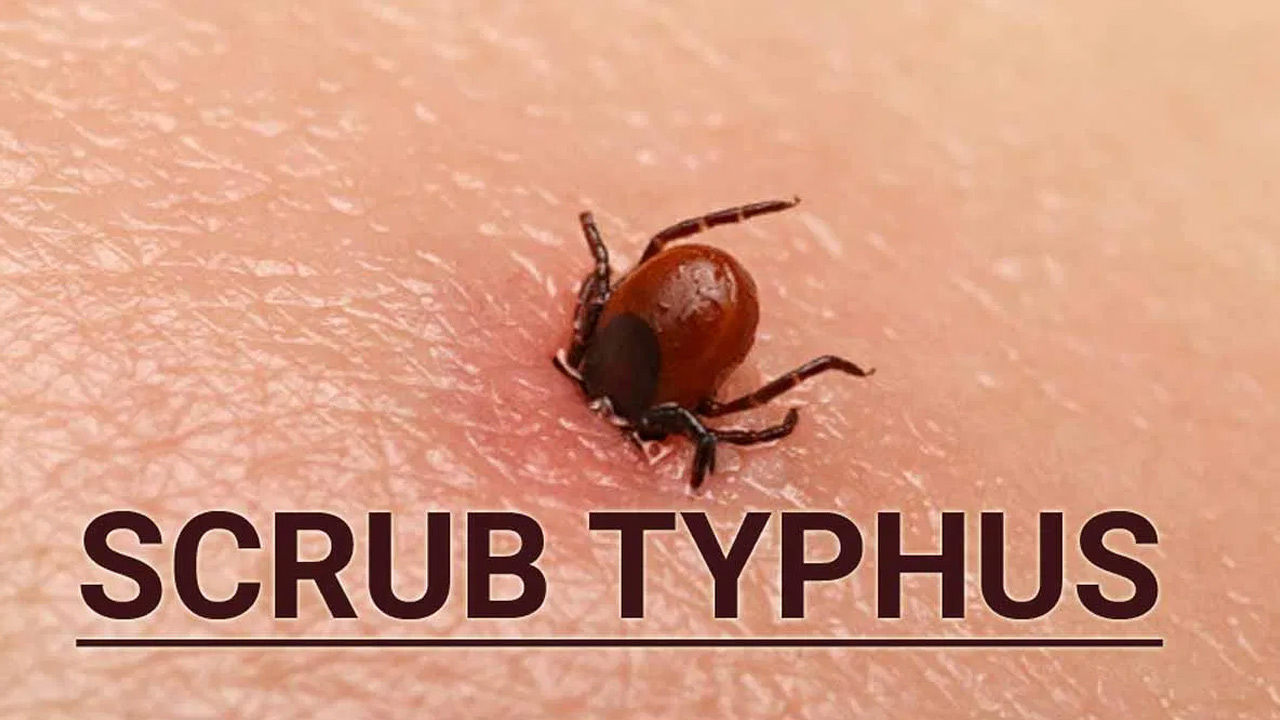Scrub Typhus: బెంగాల్ లో స్క్రబ్ టైఫస్ వ్యాధి కల్లోలం… పెరుగుతున్న బాధితులు