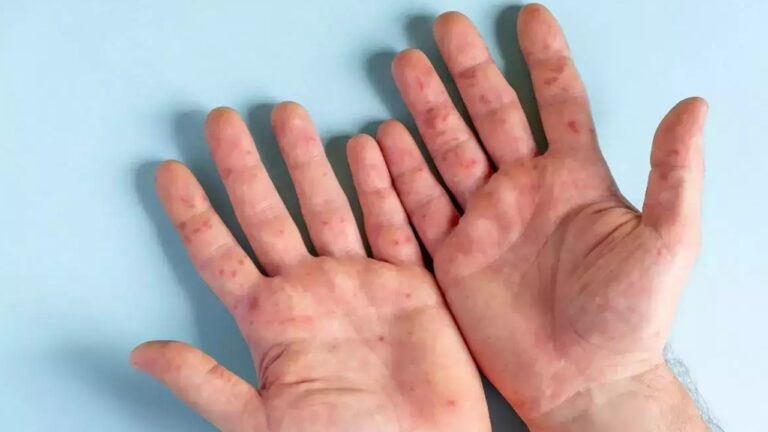 Kerala: కేరళలో కొత్త రకం వైరస్… కంగారు పెడుతున్న టమాటో ఫ్లూ