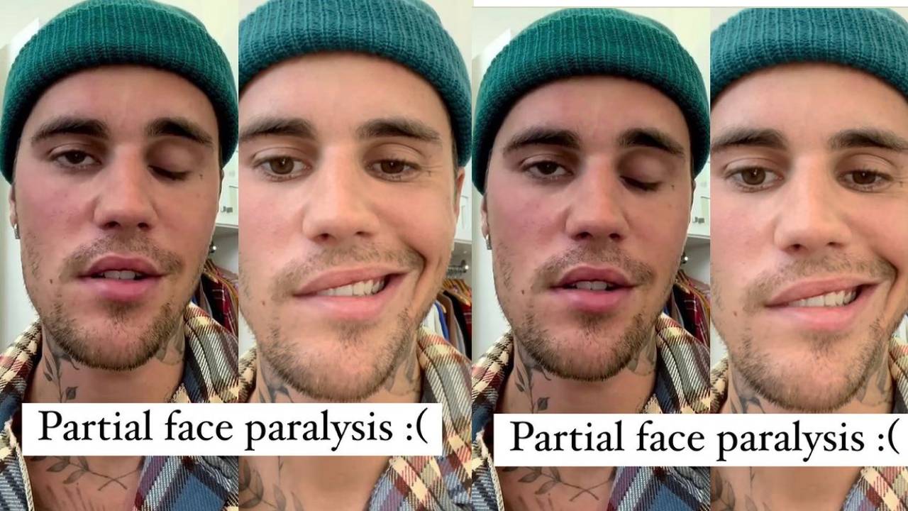 justinbieber  : పాప్ సింగర్ జస్టిన్ బీబర్ కి ముఖ పక్షవాతం
