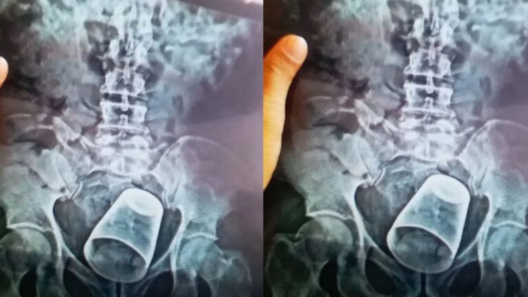 Viral: మలద్వారం లోపలికి స్టీల్ గ్లాస్.. వైద్యులు ఏం చేశారంటే?