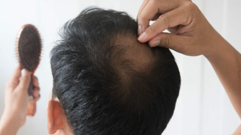 Hair Fall: జుట్టు అధికంగా రాలుతోందా? ఇవి తినండి చాలు..!