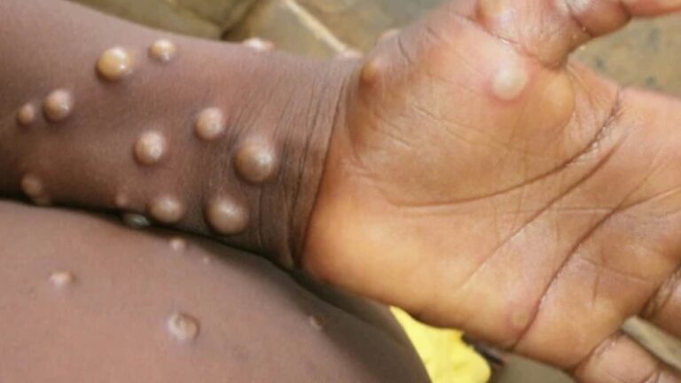 Monkeypox: ఫేస్ టు ఫేస్.. డైరెక్ట్ అటాక్
