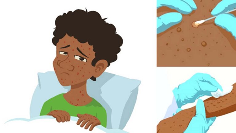 Monkey Pox: ఫ్రాన్స్‌ను వణికిస్తున్న మంకీపాక్స్‌.. ఒక్కరోజులోనే 51 కేసులు