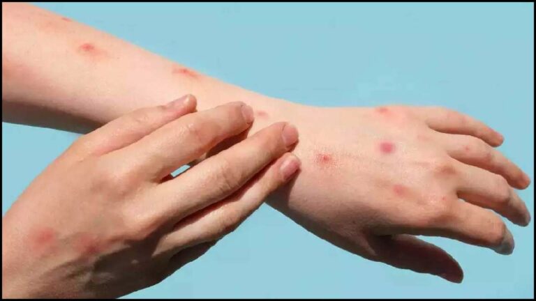 Monkey Pox: ఖమ్మంలో అనుమానాస్పద కేసు.. హైదరాబాద్‌కు తరలింపు