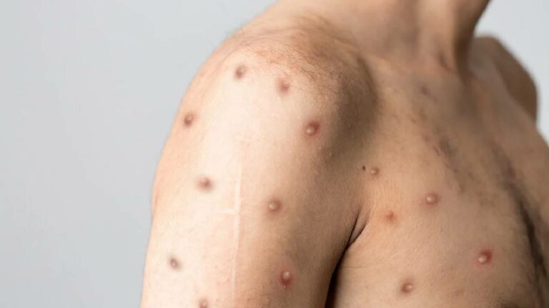 Monkeypox: ఇండియాలో మంకీపాక్స్ అనుమానిత కేసు.. ఎక్కడంటే..