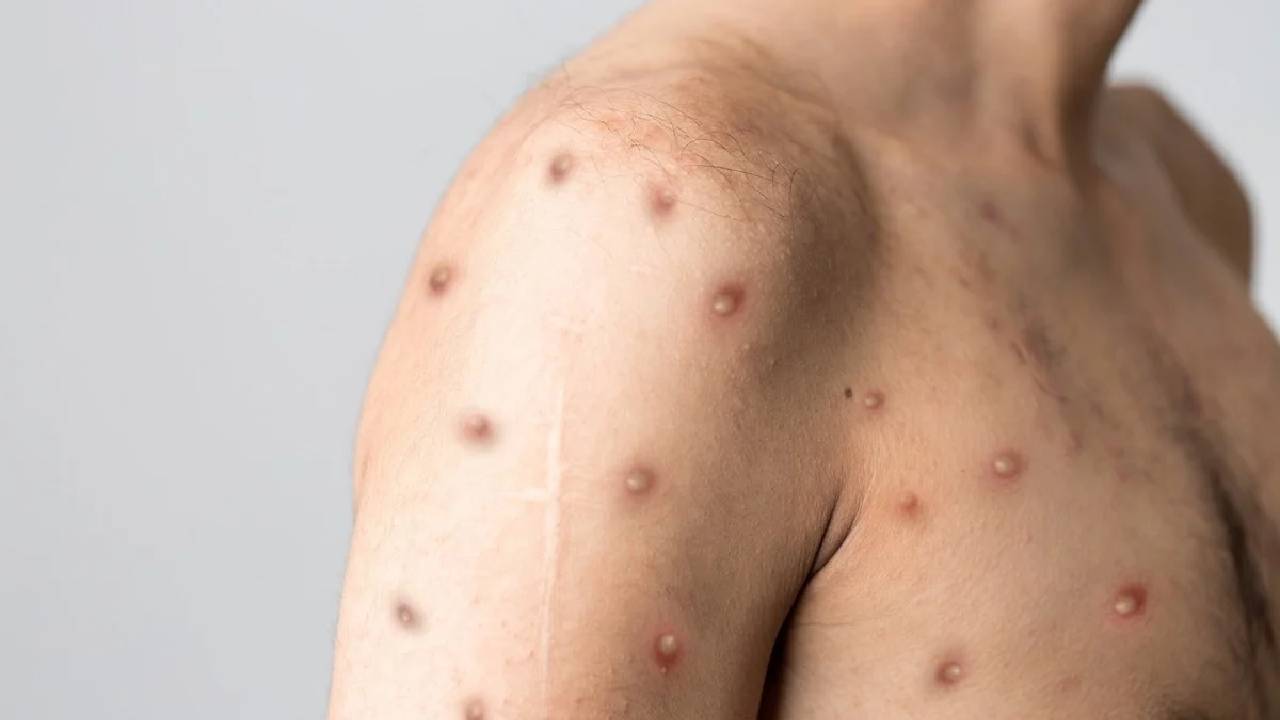 Monkeypox: ఇండియాలో మంకీపాక్స్ అనుమానిత కేసు.. ఎక్కడంటే..