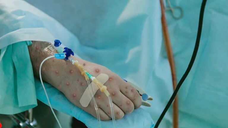 Monkeypox: ప్రపంచ ఆరోగ్య అత్యవసర స్థితిని ప్రకటించిన డబ్ల్యూహెచ్ఓ