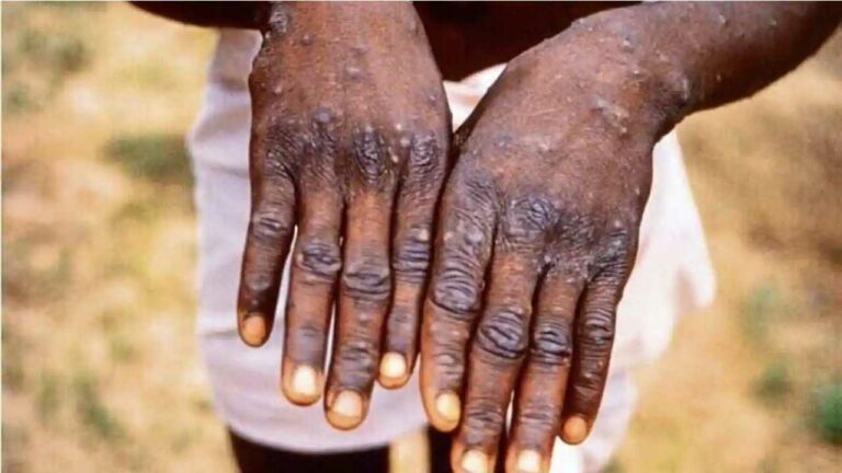 Monkeypox: ఇండియాలో మరో మంకీపాక్స్ కేసు.. ట్రావెల్ హిస్టరీ లేని వ్యక్తిలో వైరస్ గుర్తింపు