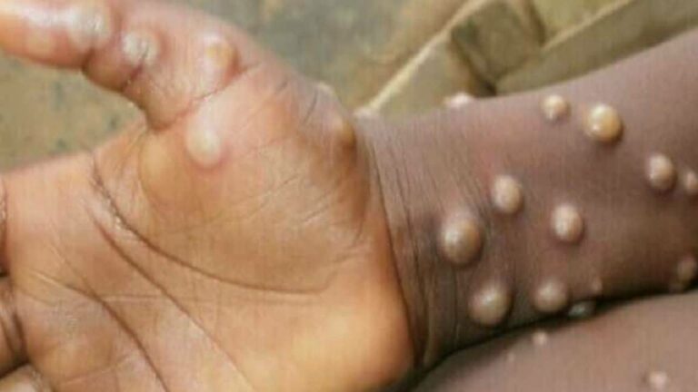 Monkeypox: దేశంలో మరో మంకీపాక్స్ కేసు.. మూడుకు చేరిన కేసుల సంఖ్య