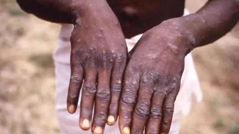 Monkeypox: అది చేయడం వల్లే 95 శాతం మంకీపాక్స్ కేసులు