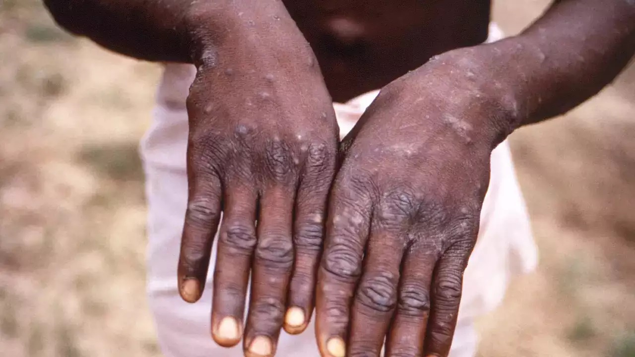 Monkeypox: అది చేయడం వల్లే 95 శాతం మంకీపాక్స్ కేసులు
