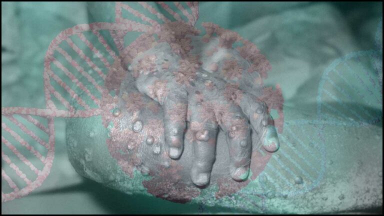 Monkey Pox: గుంటూరులో అనుమానిత కేసు