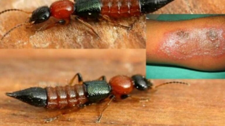 Nairobi Flies: డేంజరస్ ఈగలు..100 మంది విద్యార్థులకు స్కిన్ ఇన్ఫెక్షన్