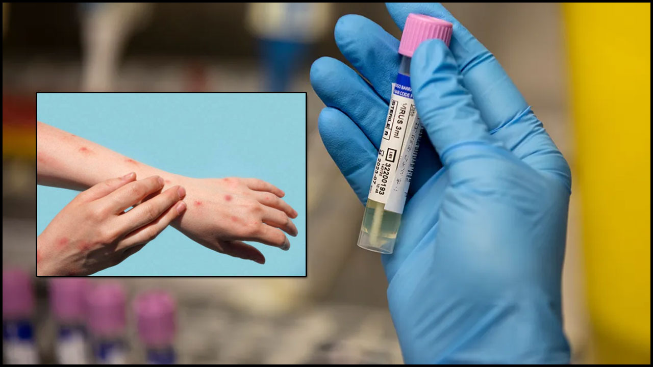 Monkey Pox: దేశంలో రెండో కేసు నమోదు.. కేంద్రం హై అలర్ట్