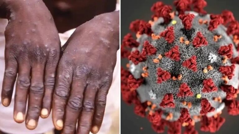 Monkeypox Cases: ఒకే వ్యక్తిలో మంకీపాక్స్, కరోనా.. అధికారుల హైఅలర్ట్