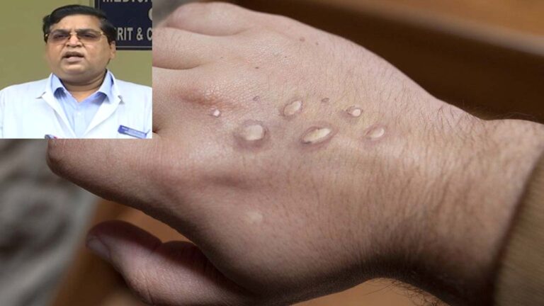 Monkeypox: గాలి ద్వారా మంకీపాక్స్ సోక‌దు.. అలాచేస్తేనే సోకే అవకాశం వుంది..?