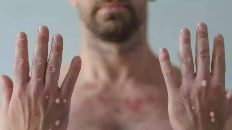 Monkeypox: స్పెయిన్ లో తొలి మంకీపాక్స్ మరణం.. యూరప్ లోనే మొదటి మరణం