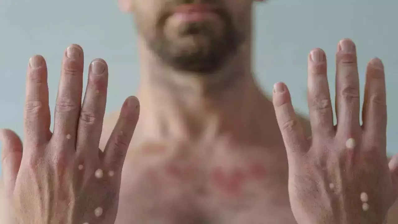 Monkeypox: స్పెయిన్ లో తొలి మంకీపాక్స్ మరణం.. యూరప్ లోనే మొదటి మరణం