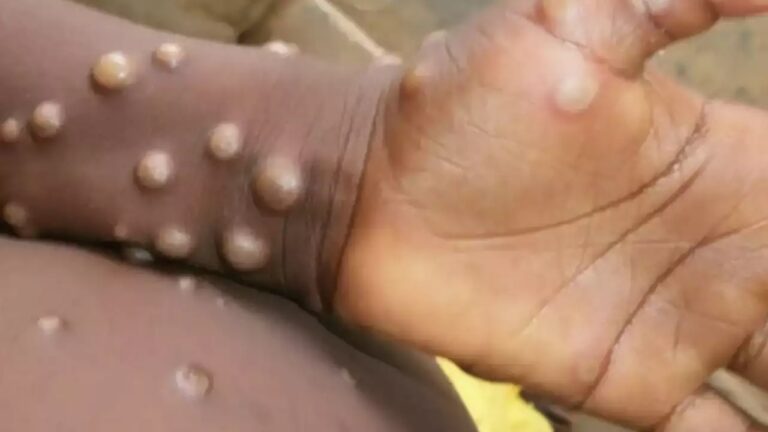 Monkeypox: కామారెడ్డి జిల్లాలో మంకీపాక్స్ కలకలం!