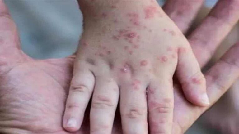 Monkeypox in Children : తొలిసారిగా పిల్లల్లో మంకీపాక్స్‌ గుర్తింపు