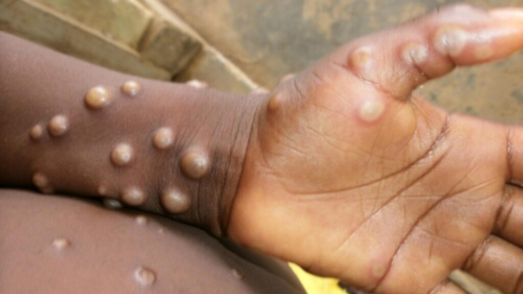 Monkeypox Virus