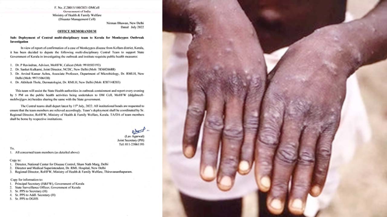 Monkey Pox: దేశంలో తొలికేసు.. నేటి నుంచి నగరంలో మంకీ పాక్స్‌ టెస్టులు