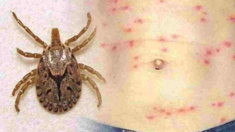 Scrub Typhus: బెంగాల్లో ప్రబలుతున్న స్క్రబ్ టైఫస్ వ్యాధి.