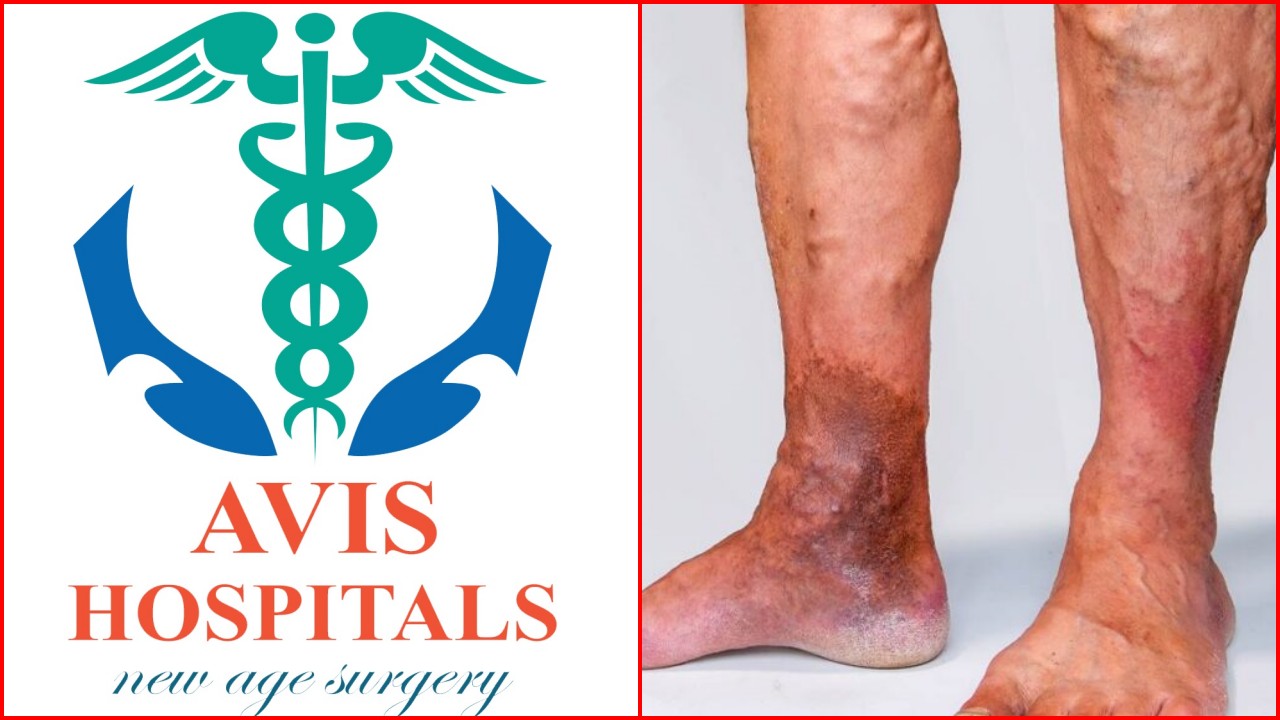Avis Hospitals: వేరికోస్ వెయిన్స్‌కు ఆధునిక చికిత్స‌ పద్ధతులు